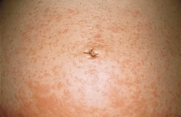 pruritic urticarial papules and plaques of pregnancy #11