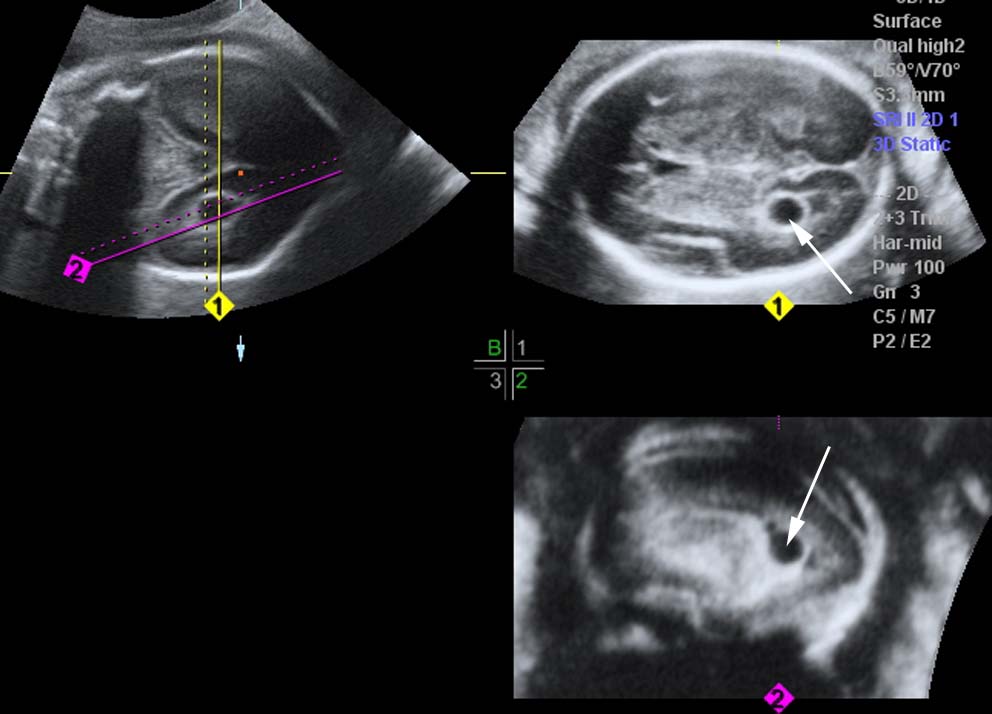 Choroidal Cyst