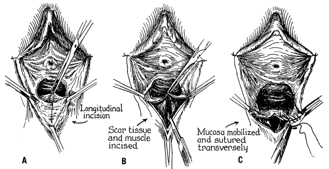 perineal body