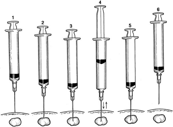 Sinus Aspiration