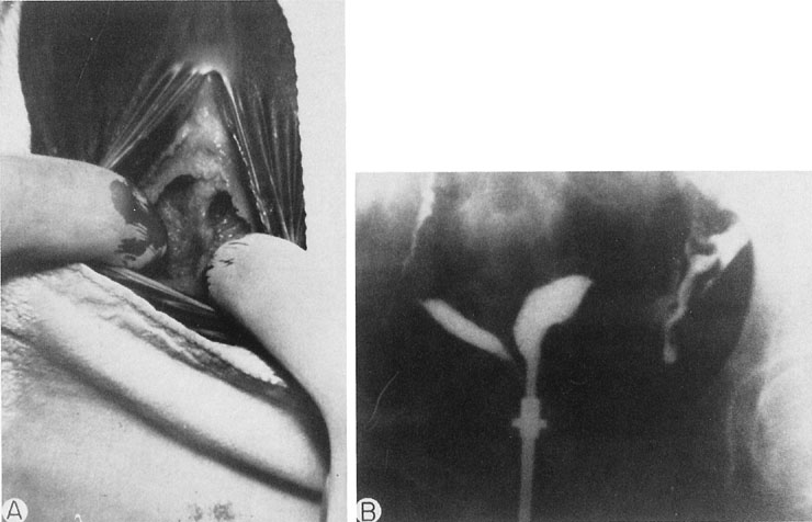 A A double vagina is noted B The hysterogram documents a double uterus 