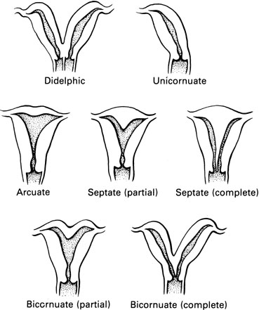 Multiple Malformation Syndrome Associated With Uterine Anomaly - Meddic