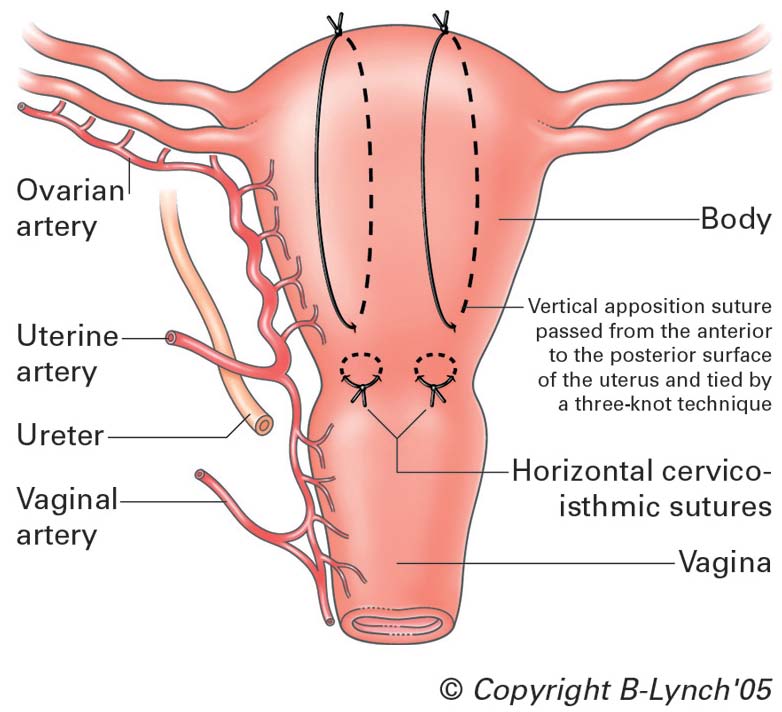 Opening Of Uterus