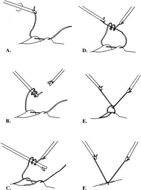 knots in abdominal obliques