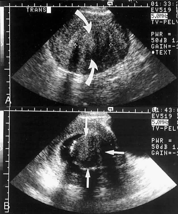 Endometrial Stripe Ultrasound