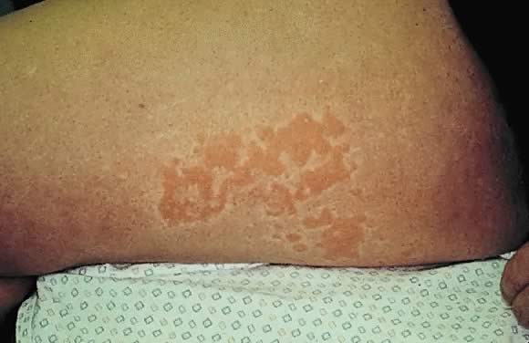 Warts On Thighs