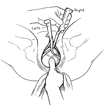 (Dennen EH (ed): Forceps Delivery. Philadelphia, FA Davis, 1955)