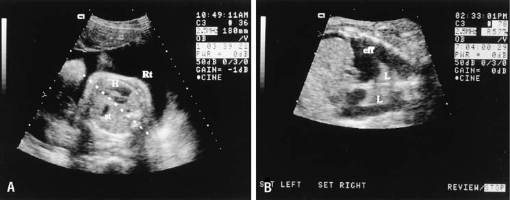 diaphragmatic hernia ultrasound