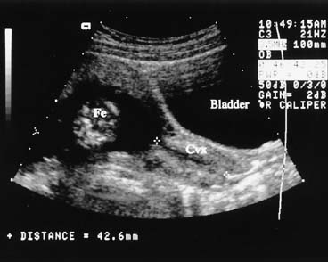 Cervix Ultrasound