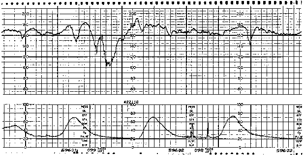 Sinusoidal Fetal Heart