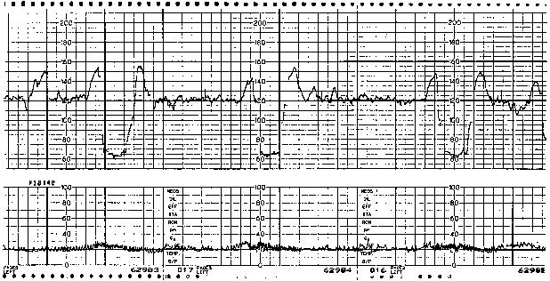 Sinusoidal Fetal Heart