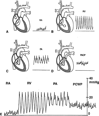 Pa Catheter Waveform