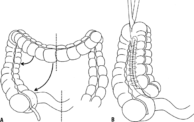 Distal Ileum