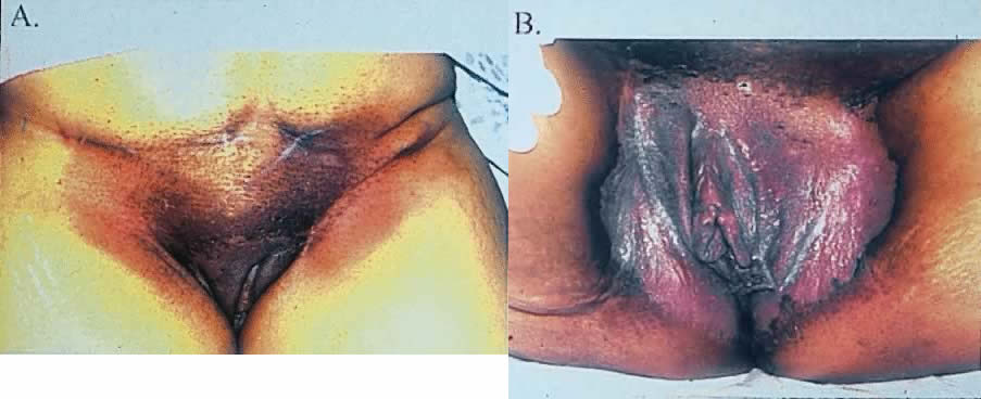 These lesions may require 2011