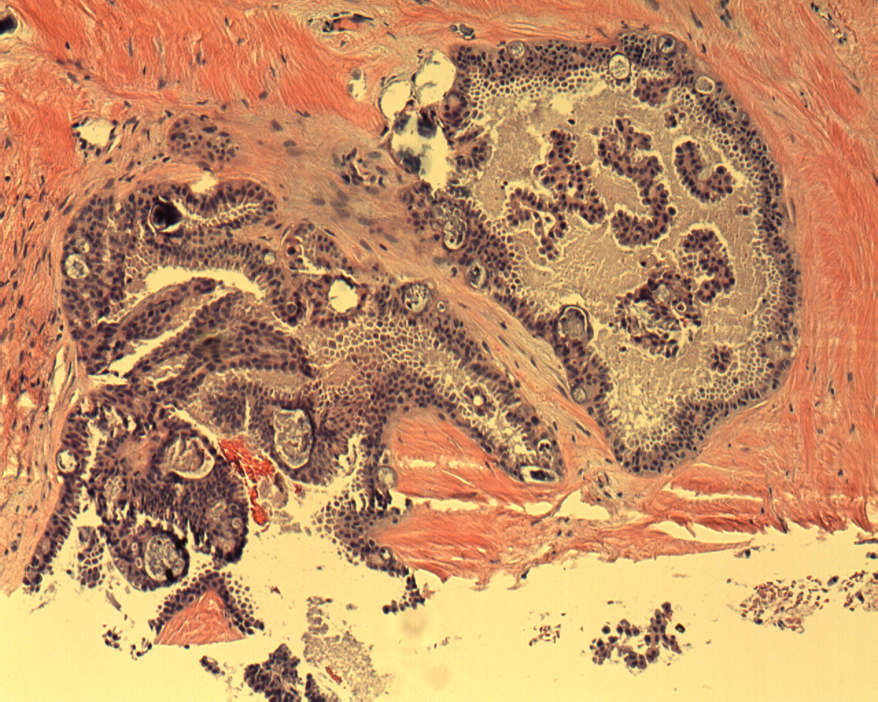 Interpapillary Peg