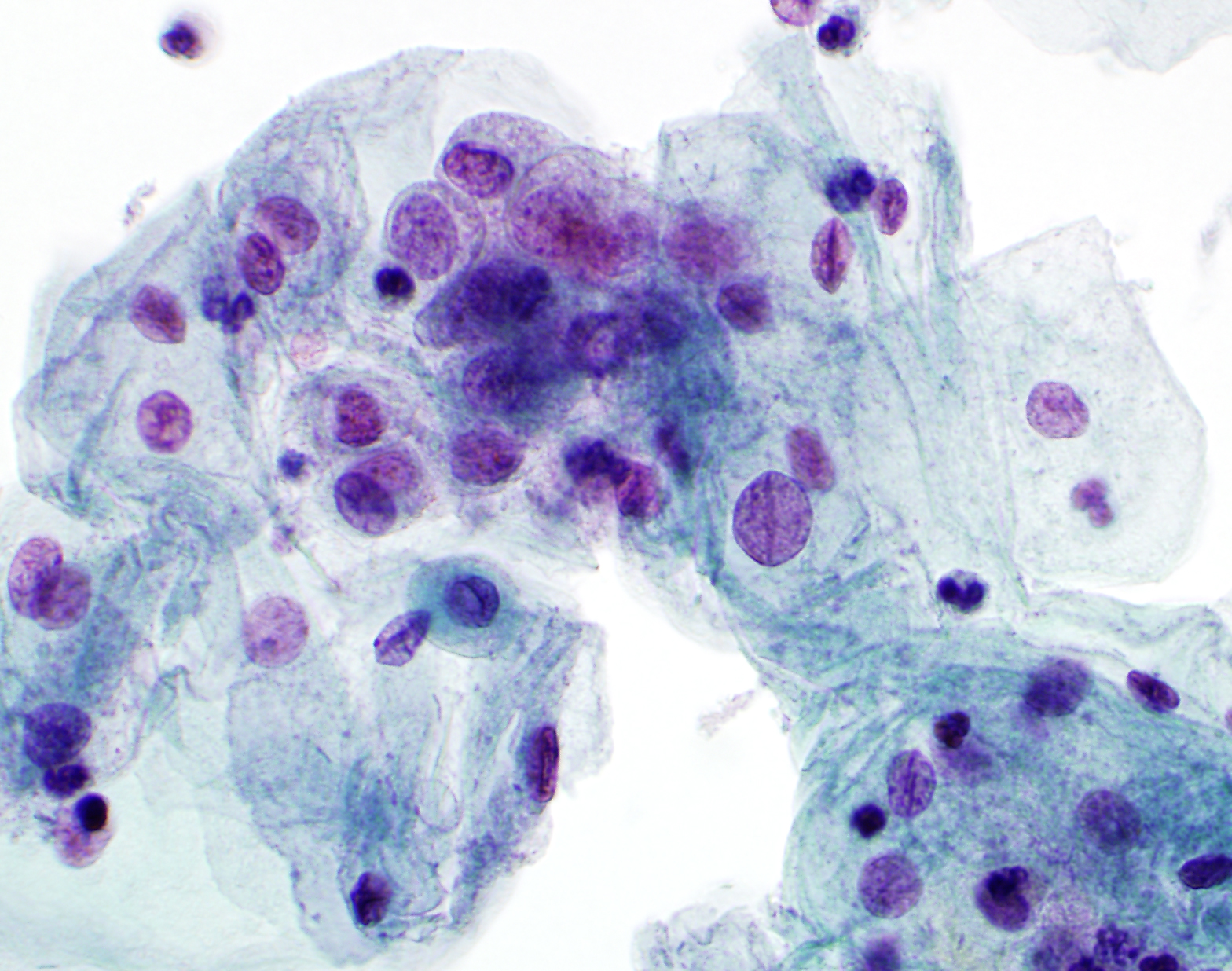 frontiers-analysis-of-the-related-factors-of-atypical-squamous-cells