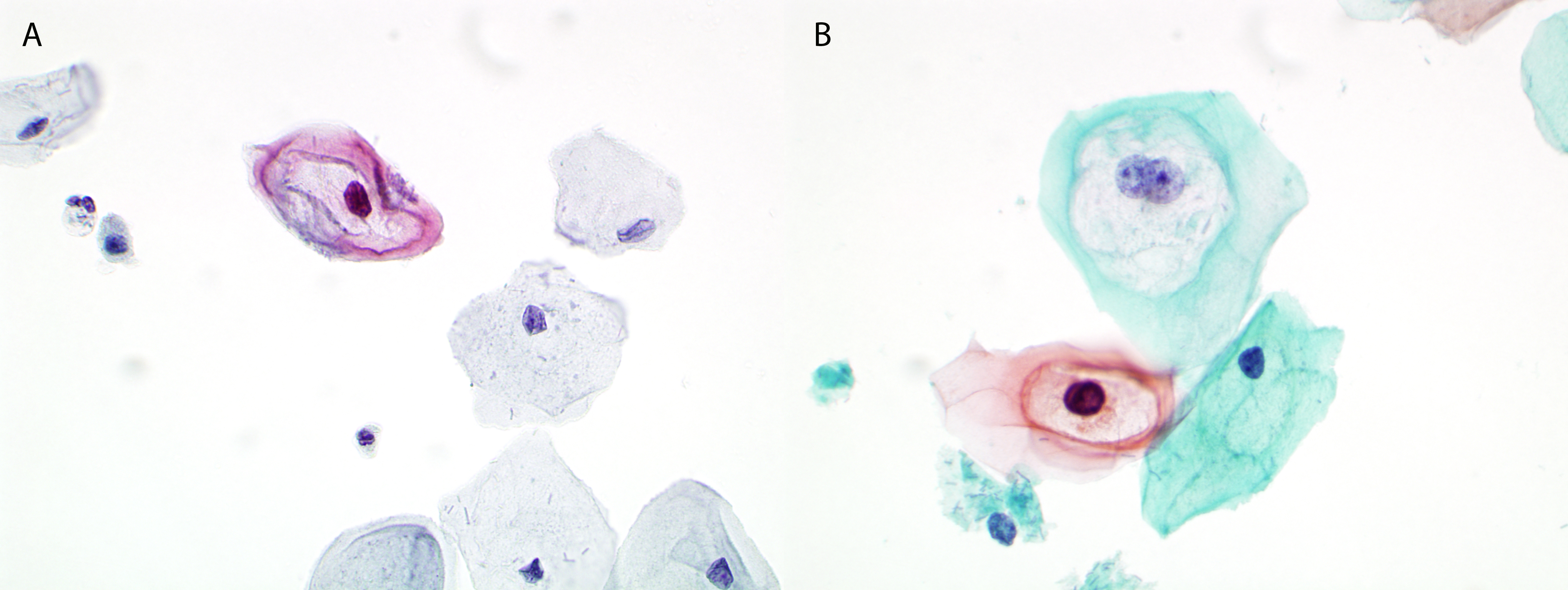 Koilocytosis Hpv