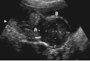 Gynecological Ultrasound