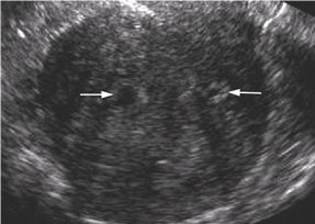 Adenomyosis Uterus Ultrasound