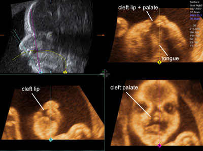 cleft palate 3d ultrasound