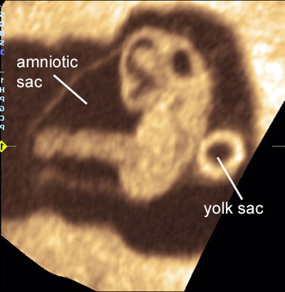 7 week transvaginal ultrasound