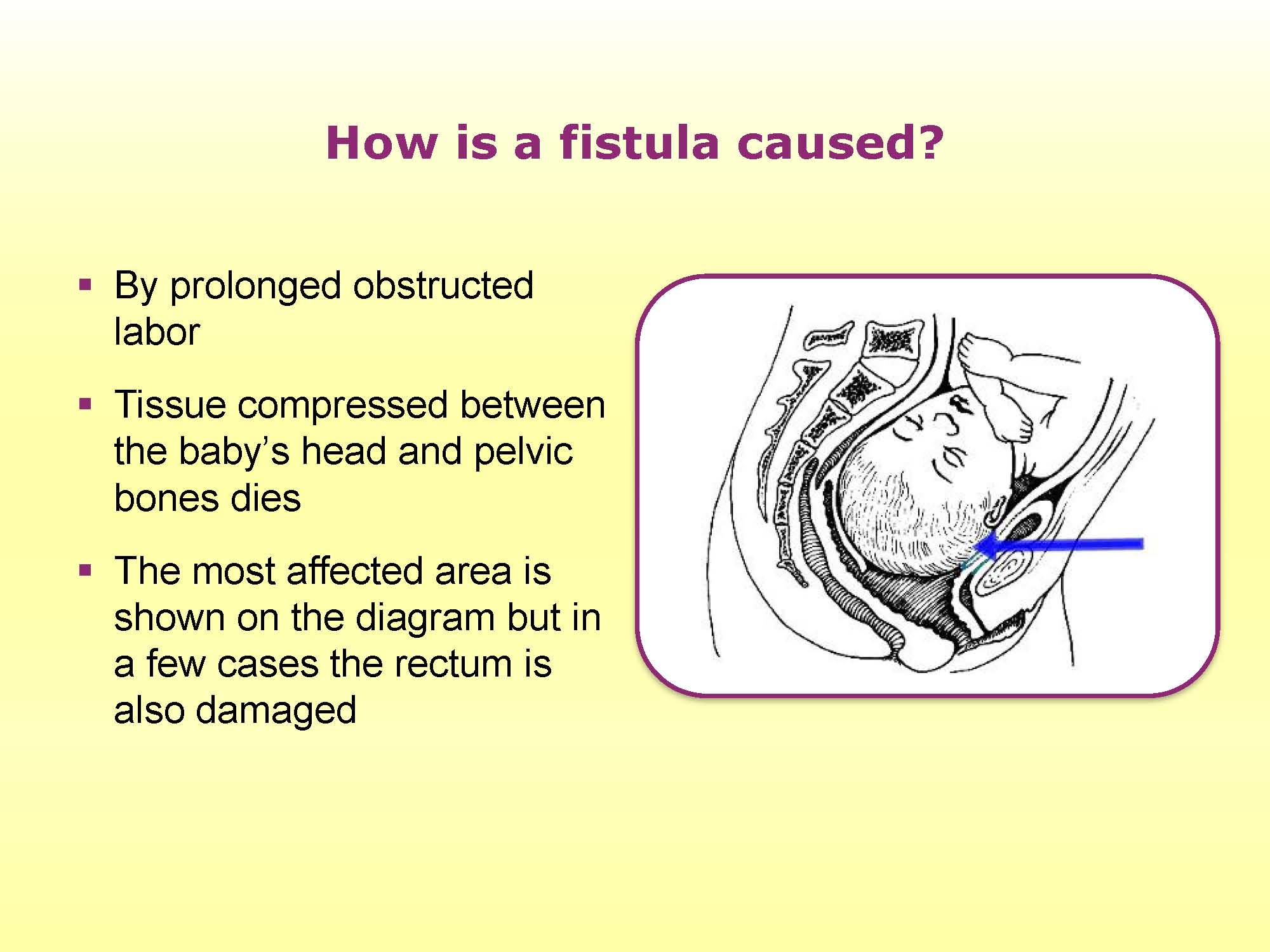 Obstetric Fistula Wikipedia, 45% OFF | gbu-hamovniki.ru