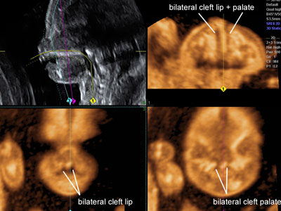 bilateral cleft lip. 09_cleft-lip-and-palate-