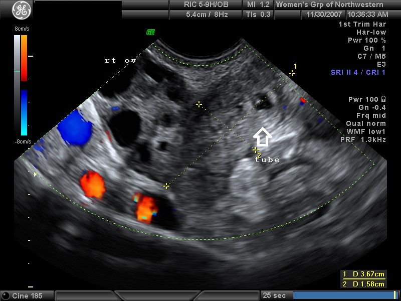 Diagnostic Ultrasound In The First Trimester Of Pregnancy Glowm