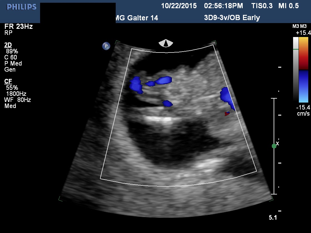 Diagnostic Ultrasound In The First Trimester Of Pregnancy Glowm